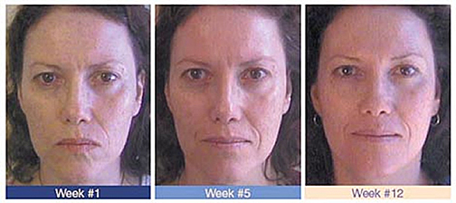 Miami Cosmetic Acupuncture Before and After. The impressive results of VBT™ in action can be clearly seen in this test subject. Only twelve weekly treatment sessions show remarkable rejuvenation and softening of the skin and facial features.