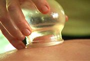 Cupping in Miami Acupuncture Clinic